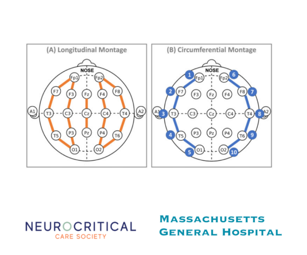 Ceribell montage EEG graphic